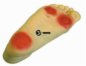 高級糖尿病足護理模型