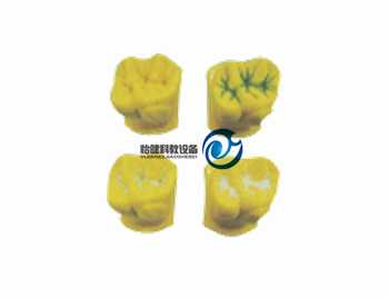 窩溝封閉演示模型