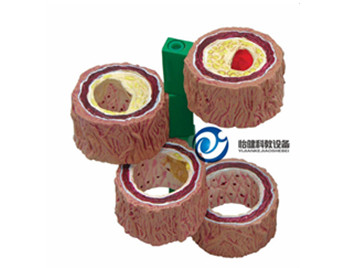 動脈硬化帶血栓模型（柱型）