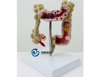 大腸病變模型