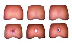 壓瘡病情演變模型