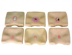 各期褥瘡護理模型